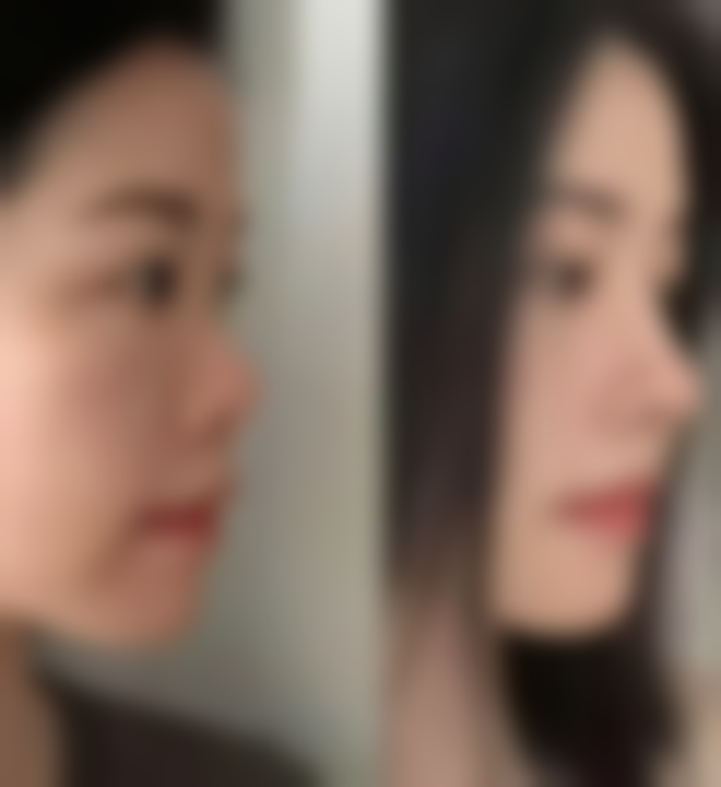 割双眼皮14天肿了要就医吗——精细判断就医时机