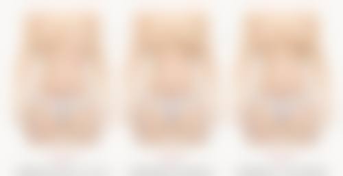 术后护理保护下自体脂肪移植隆胸的成效好吗