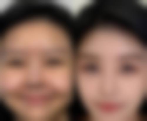 全切双眼皮要提肌吗:提肌手术的本质与关联