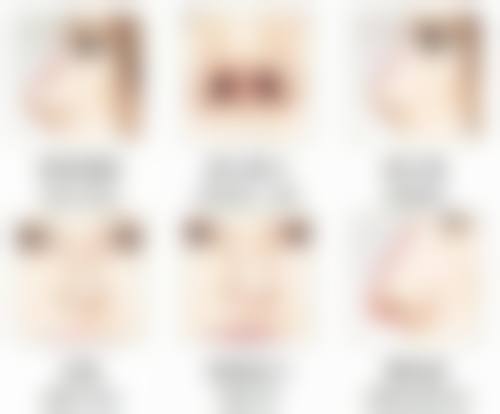 北上广三等甲医院揭秘:全切双眼皮提肌费用详情