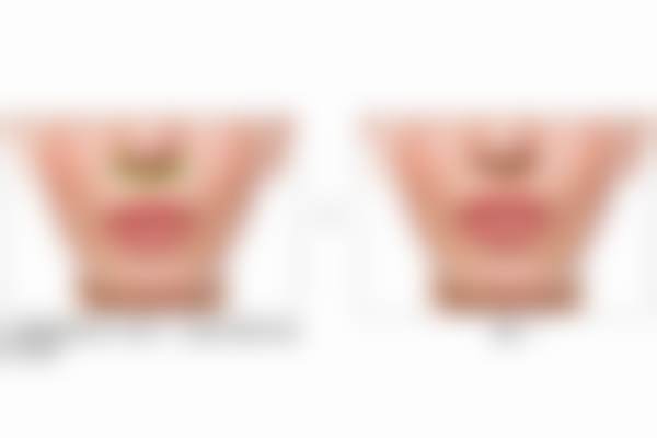 【回颜臻童颜45mg聚左旋乳酸PLLA+45】福州海峡张光泽主事项目顾客实例