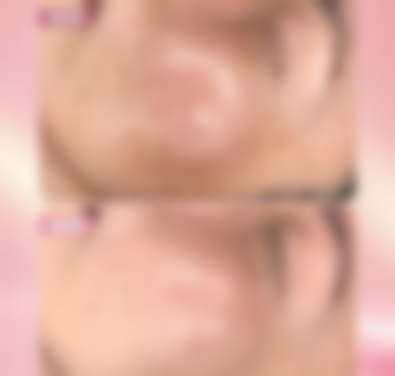 假体隆胸260成效如何——亚洲女性的C杯神器