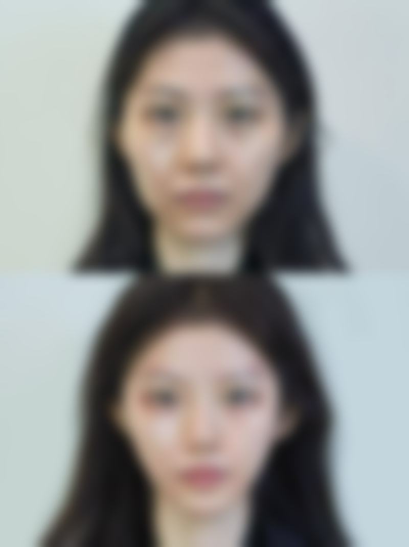 疤痕增生疙瘩用什么祛疤膏之有名祛疤膏深度解析