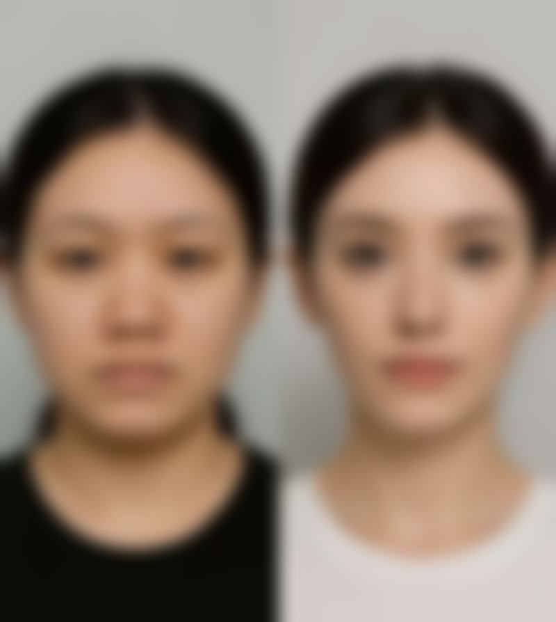 自体脂肪隆胸反弹情况下自体脂肪移植隆胸的成效好吗