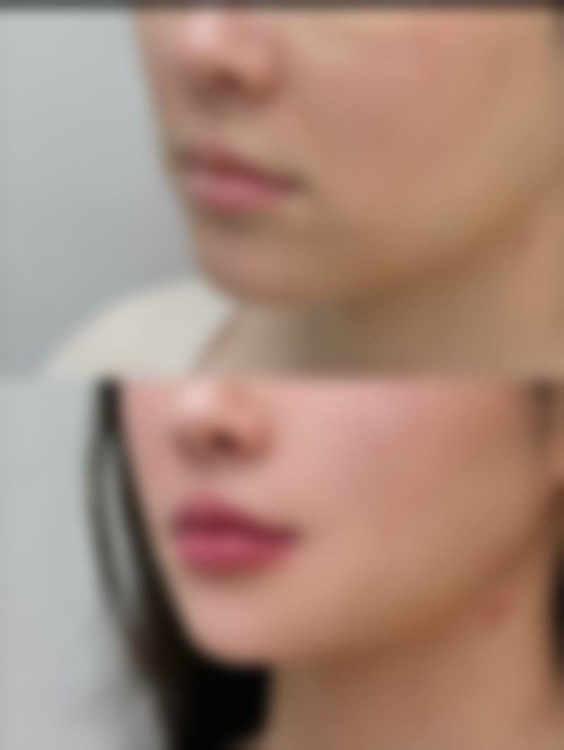 疤痕增生疙瘩用什么祛疤膏