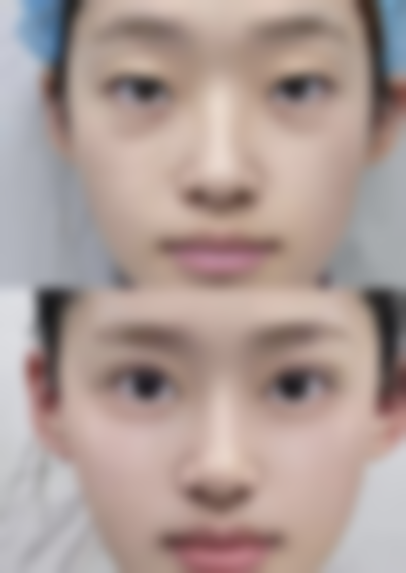 瘦脸针不能吃的头孢类消炎药之安心性澄清