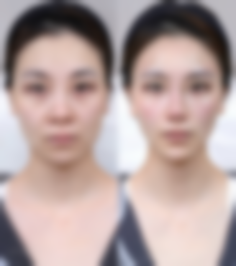 怎么判定自己是不是疤痕体质——医院的必要病理检查判定方法