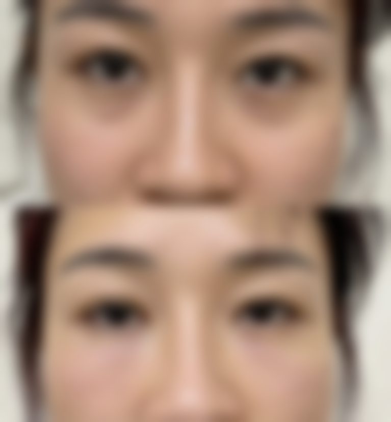 割双眼皮14天了还是肿会留疤吗