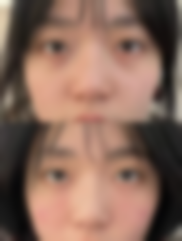 硅胶假体隆胸可以保存多久之七大关键因素