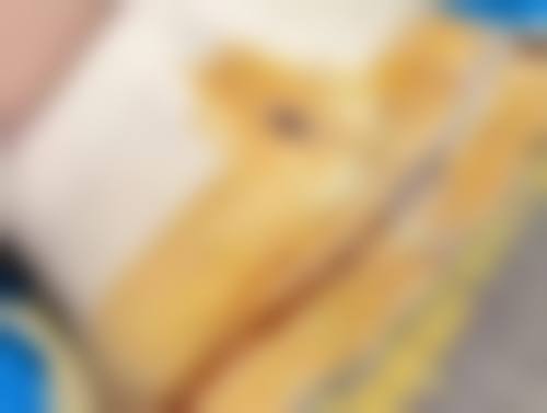 北京医院割双眼皮多少天可以出门:医疗资源优势下的修复建议