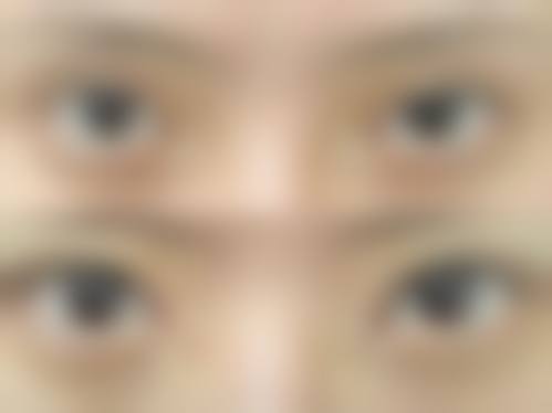 武汉斯启诺医疗美容门诊部董雷医生之真实实例见证