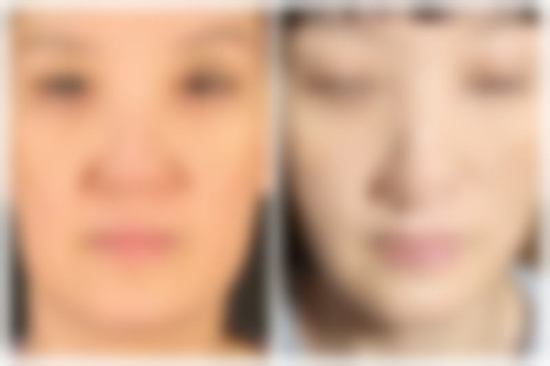 咬伤疤痕怎么去除之药物祛疤:涂抹式解决方案的精彩比拼