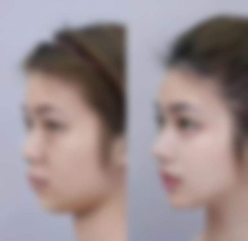 美皮护淡化疤痕红印的原理:科学机制揭秘