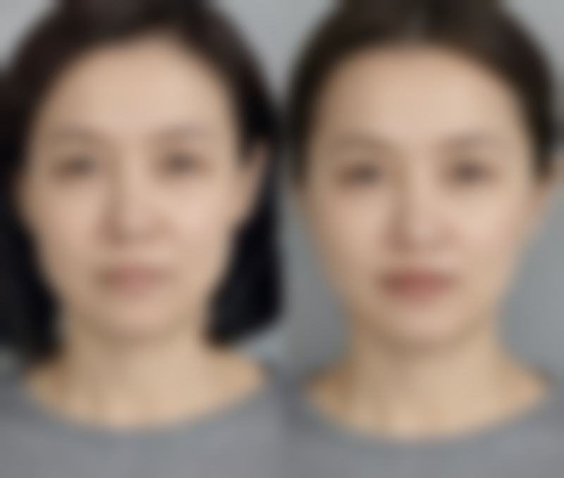 隆鼻后多久才能修复到至佳形态:三个关键阶段全知晓