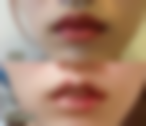 打瘦脸针后面部僵硬怎么办？3招快速缓解+恢复期护理指南