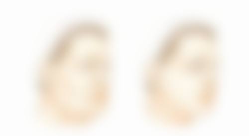 身体肥胖抽脂的注意事项指南