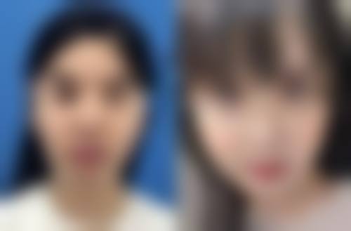 自体隆鼻软骨有什么后遗症——移位后遗症:固定期要乖乖听话