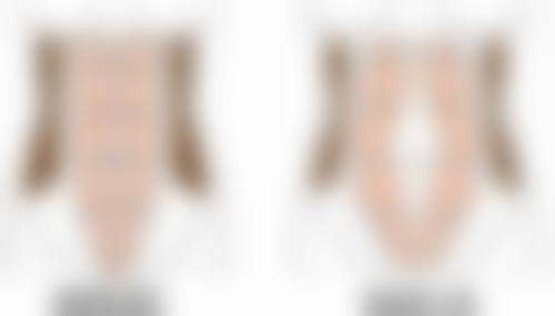 身体肥胖抽脂的成效评估