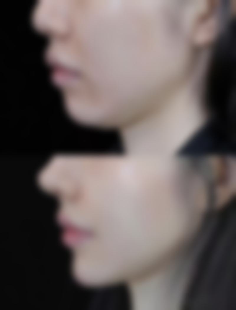 有眼袋应该怎么办之日常护理：全方面防“袋”攻略