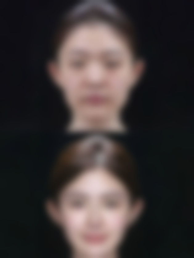 打瘦脸针后面部僵硬怎么办——3 招快速缓解术