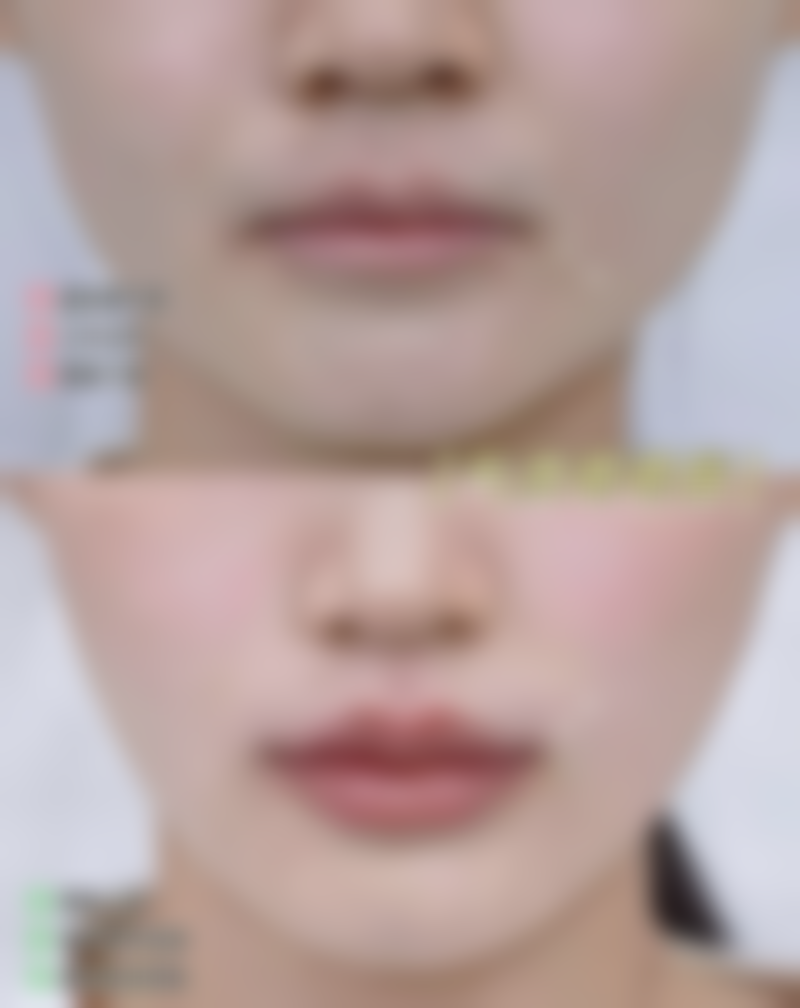 身体肥胖可以抽脂吗？揭秘风险、效果与适合年龄