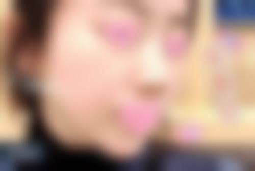 疤痕变白了怎样修复肉色素沉淀——日常护理的重要妙招