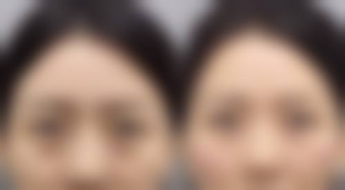 割双眼皮多久可以上班?