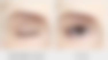 种植发际线后头发完整生长阶段剖析