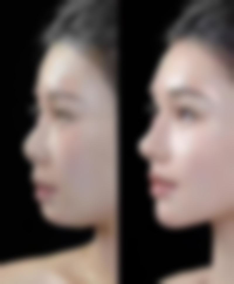 药物护理:居家去除白色痘印的秘密武器