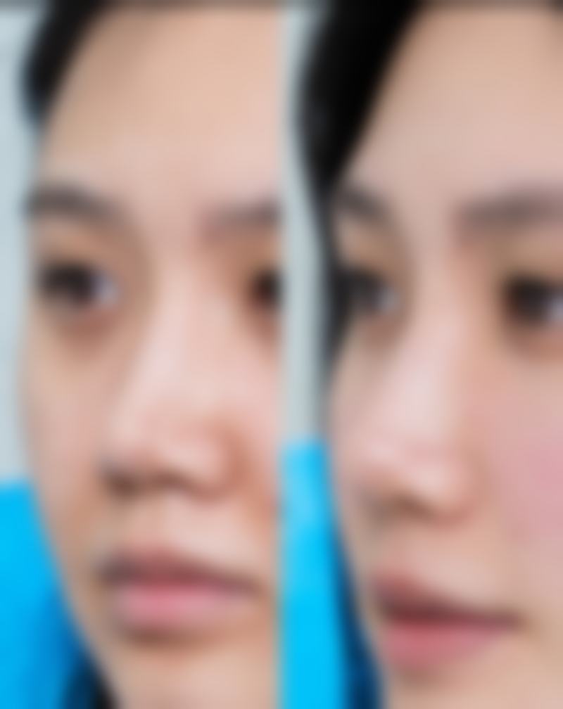 打了进口瘦脸针多久反弹:更持久成效的背后