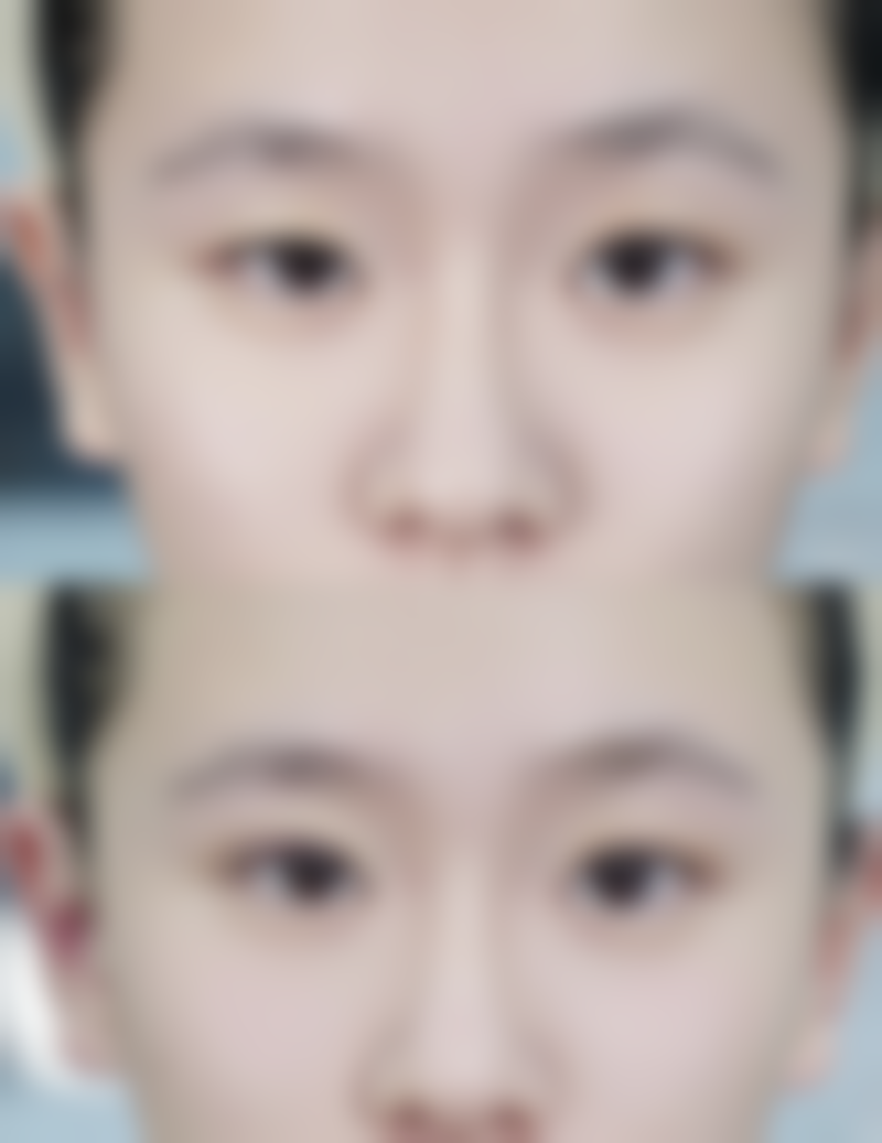 医院分析腿部抽脂后多久可以见理想成效