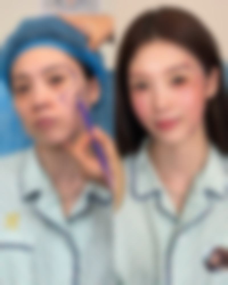 多次注射瘦脸针多久反弹:持续改善带来更持久美丽