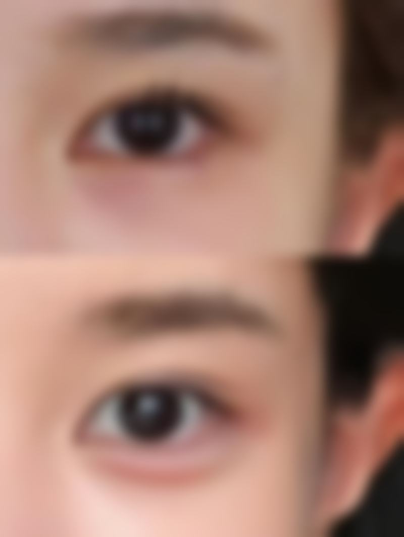 手术与其他治疗方式助力去除白色痘印