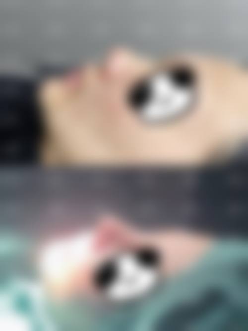 【无创注射+1000】焕肤新选择划算吗