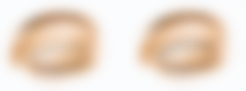 割双眼皮开眼角增生一般修复时长剖析