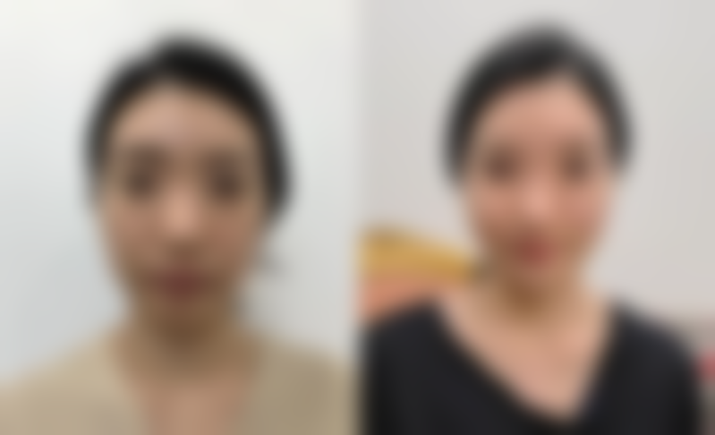 怎么样才能有效消除遗传性眼袋之医美与日常护理结合