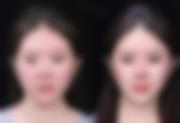 新鲜芦荟直接涂在陈旧疤痕上可行吗