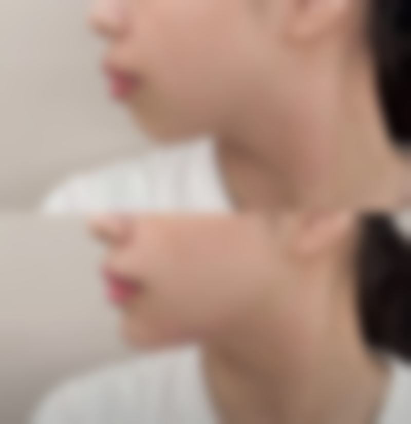 长期使用滴眼液能去眼袋吗:小心适得其反