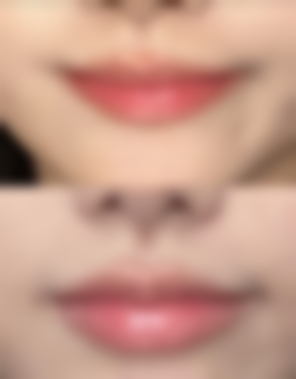 怎么样才能有效消除脂肪型眼袋之针对性方案