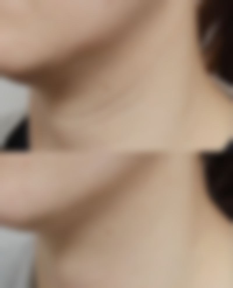 为什么疤痕愈合后会痒？神经再生+炎症反应揭秘，手术烫伤疤痕必看！