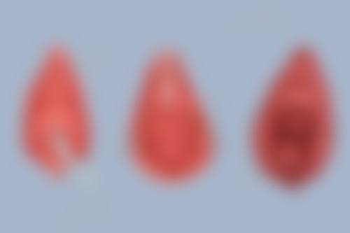 眼袋手术两侧不对称修复方法与促进修复策略