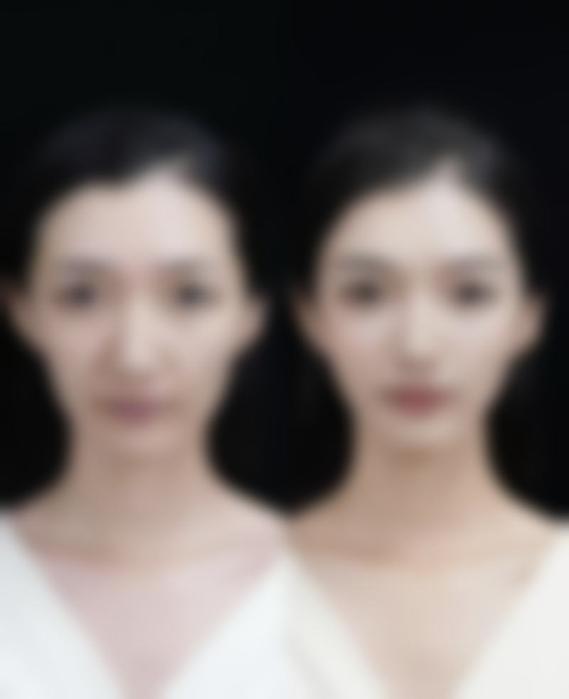 如何选择适合自己的隆鼻材料