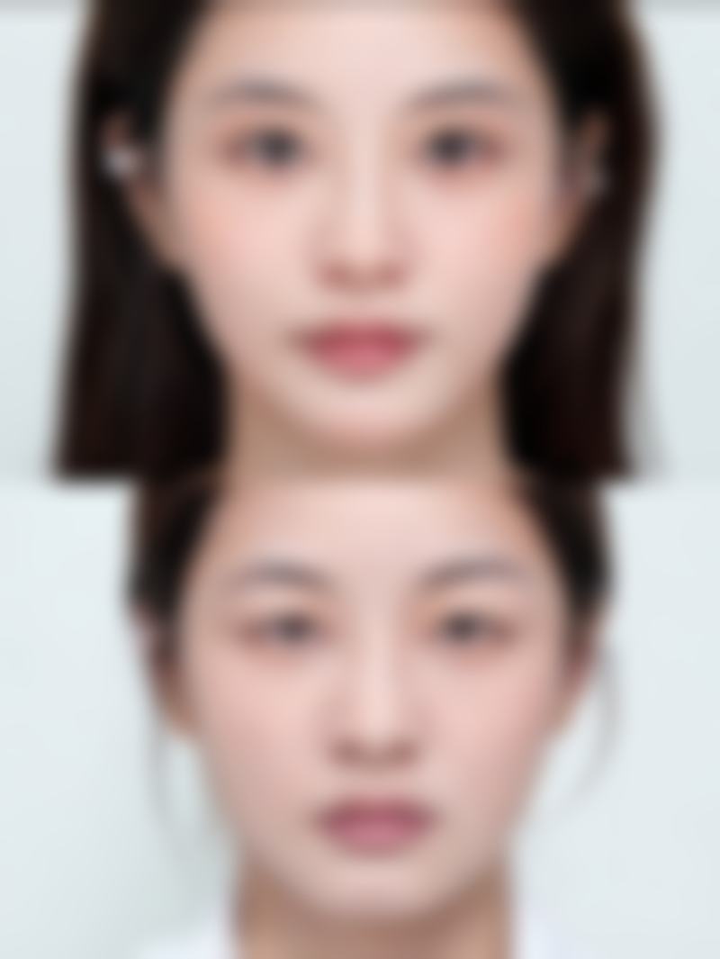 隆鼻修复期有多久