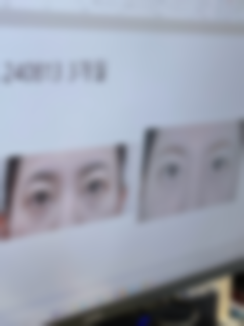 轻微烫伤后红色疤痕怎么去除之医院选择攻略