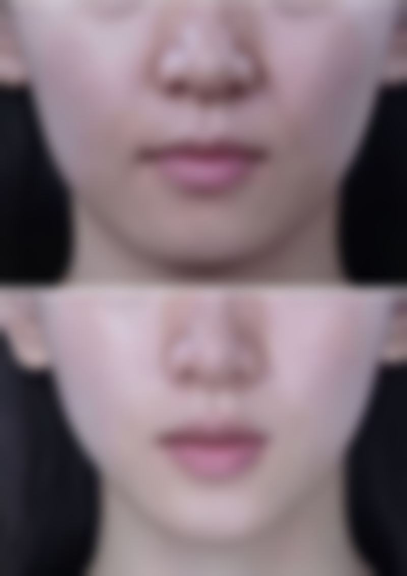 全切双眼皮切眼袋多久消肿:1个月修复期的关键点把握