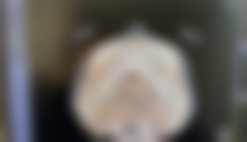 注射隆鼻修复期有多久:为什么被称为“午休美容”?