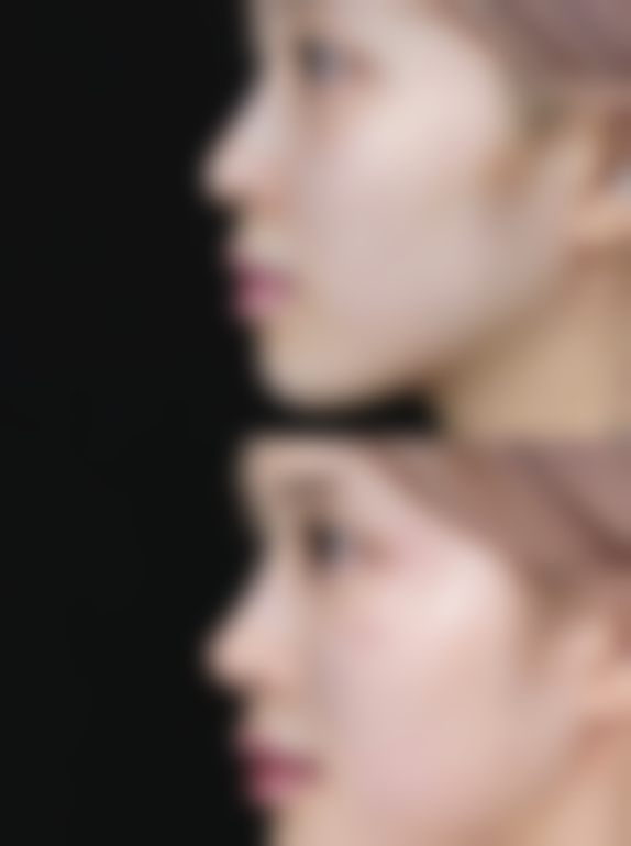 硅胶隆鼻一次能保持多久:十年品质保护,稳定之选