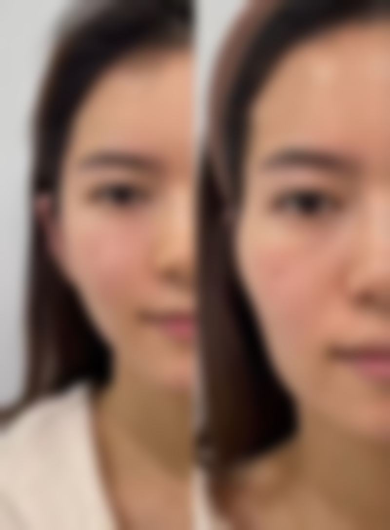 轻微烫伤后红色疤痕怎么去除之消退时间解读