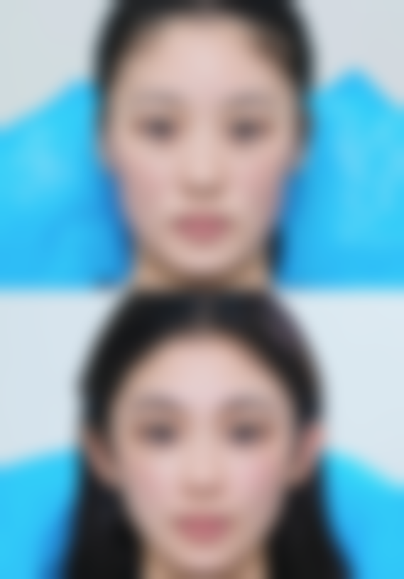 鼻子小可以隆鼻吗之三等甲医院与私立医院的抉择