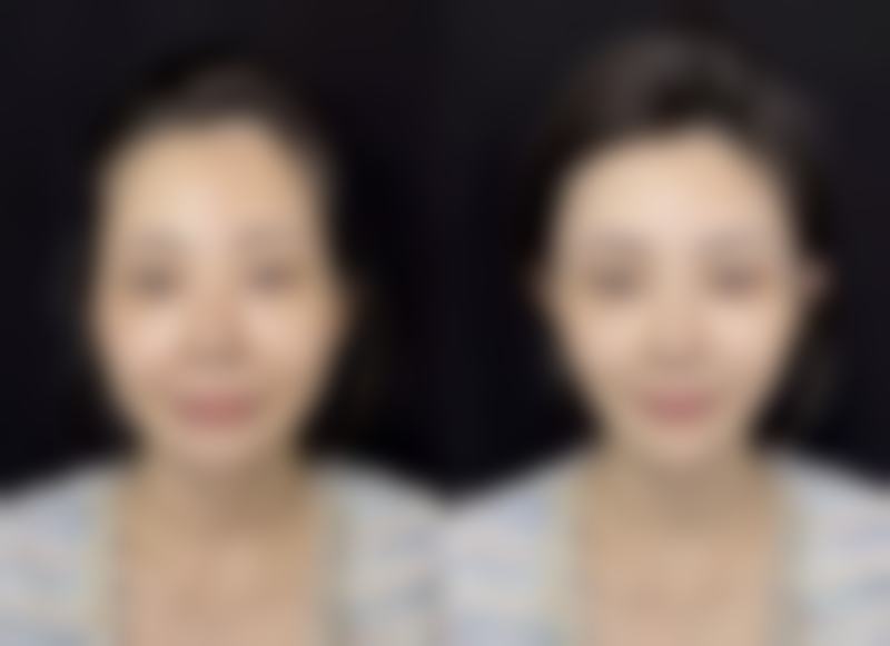 眼袋手术两侧不对称修复时间与修复可能性